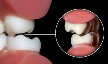 Bruksizm: Diş Gıcırdaması Neden Olur ve Nasıl Önlenir?