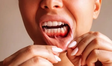 Diş Apsesine Ne İyi Gelir? Evde Kesin Çözüm Yöntemleri